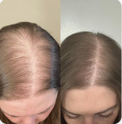 FreshOrbit PDRN Hair Ampoule™